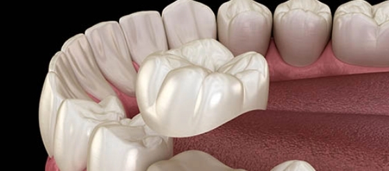 Seymour Dental Associates PLLC image of a crown procedure